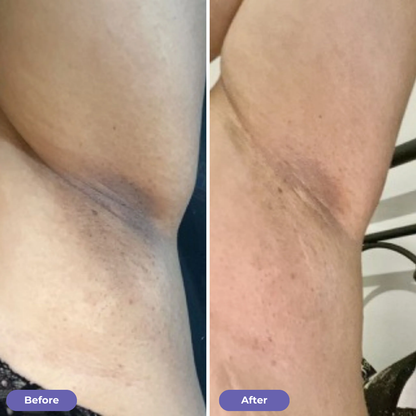 Underarm Renewal Reset™
