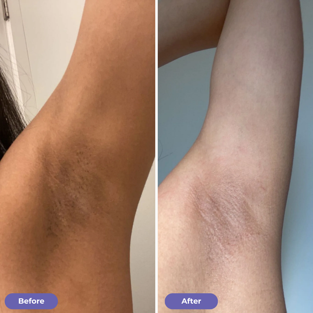 Underarm Renewal Reset™
