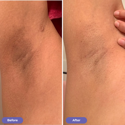 Underarm Renewal Reset™
