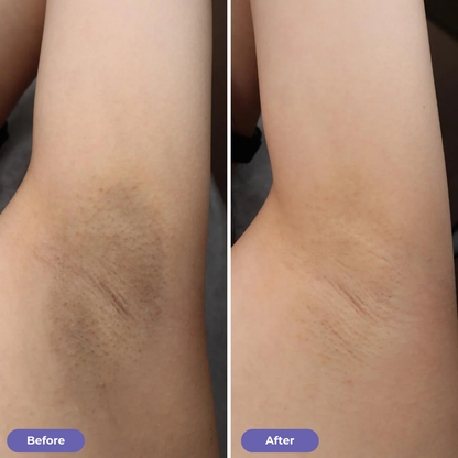 Underarm Renewal Reset™